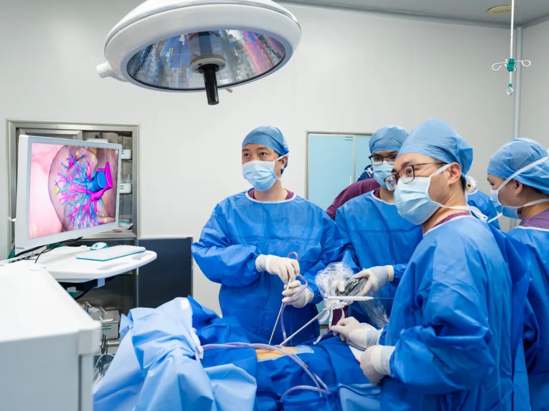 ▲省医、茂医团队采用流域2.0技术主刀肺结节手术（左一为省医广东省肺癌研究所所长钟文昭教授）