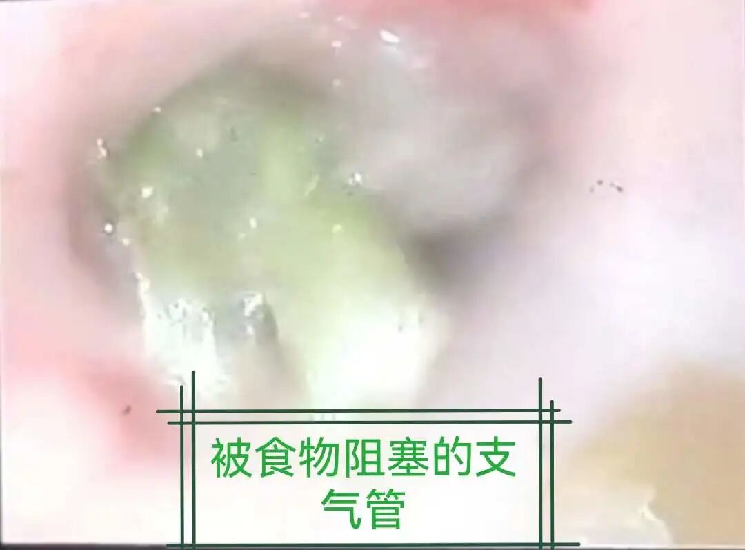 怎么给病人吸痰吸痰的那些事_https://www.jmylbn.com_新闻资讯_第9张