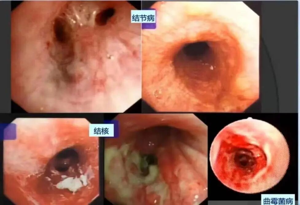 怎么给病人吸痰吸痰的那些事_https://www.jmylbn.com_新闻资讯_第11张