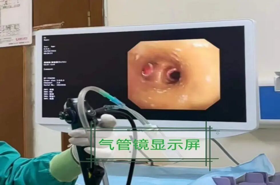 怎么给病人吸痰吸痰的那些事_https://www.jmylbn.com_新闻资讯_第8张