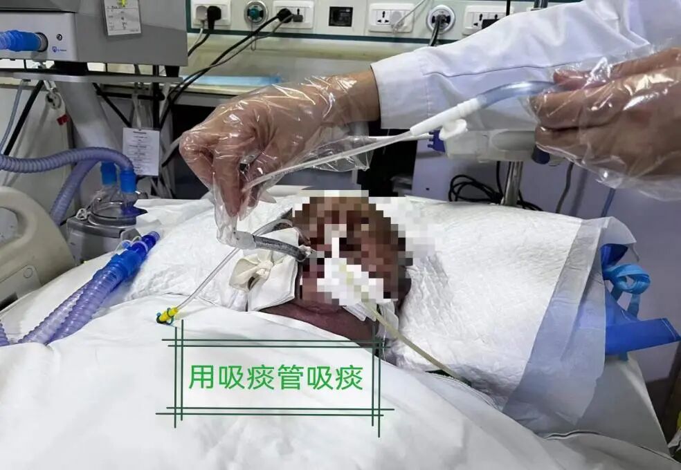 怎么给病人吸痰吸痰的那些事_https://www.jmylbn.com_新闻资讯_第4张