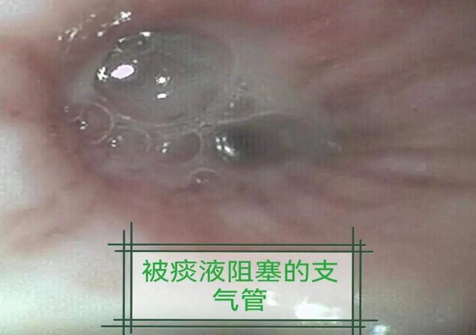 怎么给病人吸痰吸痰的那些事_https://www.jmylbn.com_新闻资讯_第10张