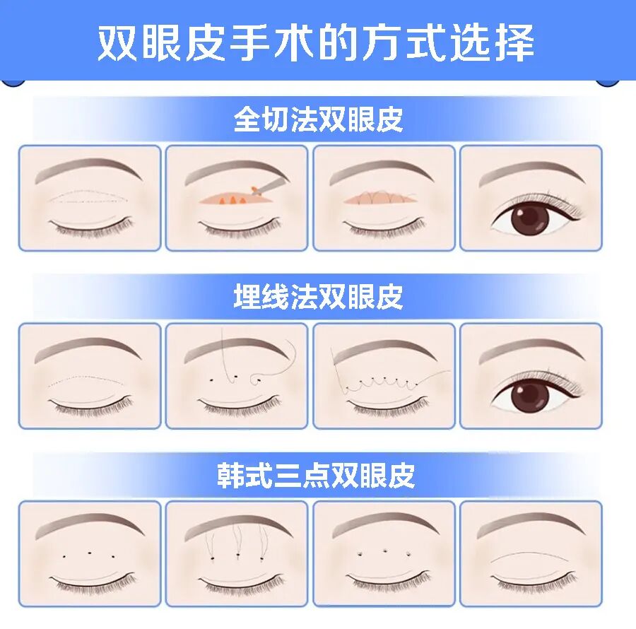 双眼皮基因是怎么遗传的？手术双眼皮都有哪些方法？插图