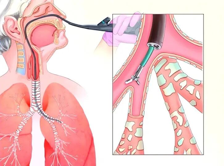 可视喉镜是什么【呼吸科普】一探究“镜”：揭开支气管镜的神秘面纱_https://www.jmylbn.com_新闻资讯_第8张