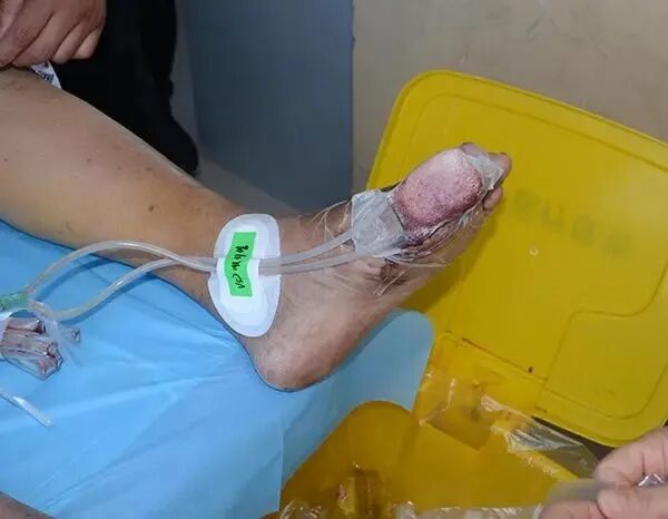 vsd敷料怎么去【文献分享】封闭式负压引流技术的临床应用进展_https://www.jmylbn.com_新闻资讯_第5张