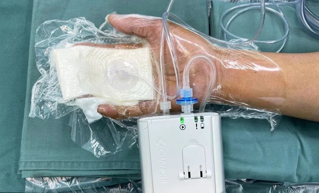 vsd敷料怎么去【文献分享】封闭式负压引流技术的临床应用进展_https://www.jmylbn.com_新闻资讯_第6张