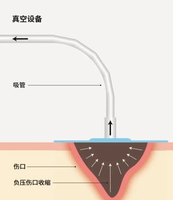 vsd敷料怎么去【文献分享】封闭式负压引流技术的临床应用进展_https://www.jmylbn.com_新闻资讯_第4张