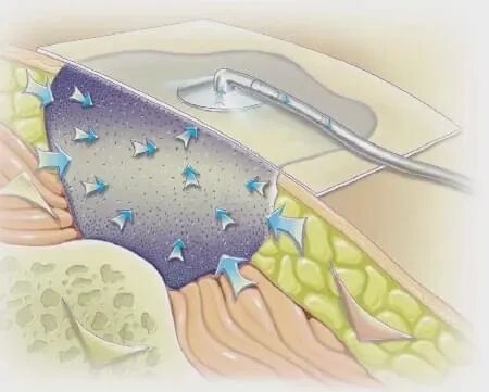 vsd敷料怎么去【文献分享】封闭式负压引流技术的临床应用进展_https://www.jmylbn.com_新闻资讯_第2张