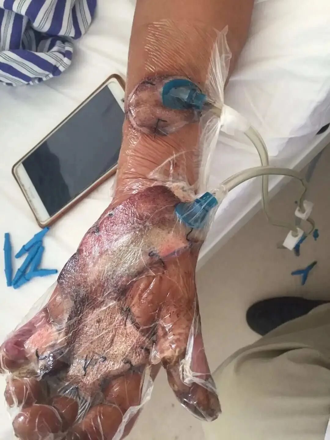 vsd敷料怎么去【文献分享】封闭式负压引流技术的临床应用进展_https://www.jmylbn.com_新闻资讯_第3张