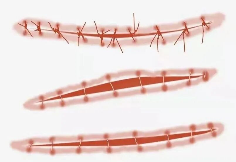 硅凝胶敷料怎么样常规治疗增生性瘢痕首选——硅凝胶敷料！_https://www.jmylbn.com_新闻资讯_第9张