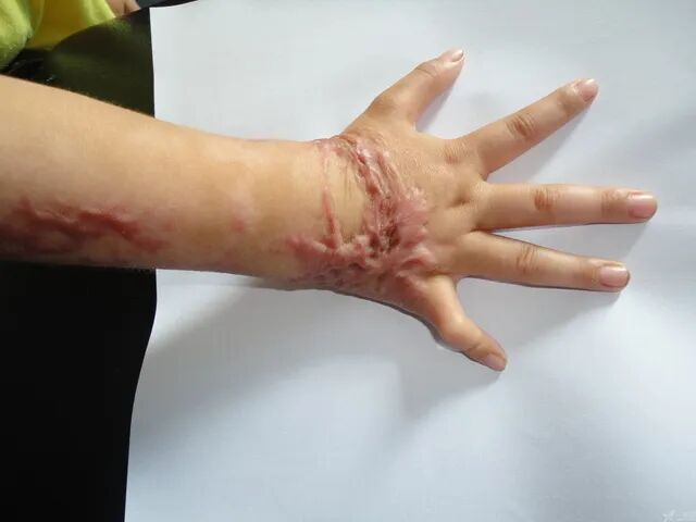 硅凝胶敷料怎么样常规治疗增生性瘢痕首选——硅凝胶敷料！_https://www.jmylbn.com_新闻资讯_第2张