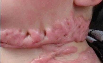 硅凝胶敷料怎么样常规治疗增生性瘢痕首选——硅凝胶敷料！_https://www.jmylbn.com_新闻资讯_第3张