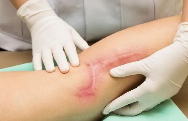 硅凝胶敷料怎么样常规治疗增生性瘢痕首选——硅凝胶敷料！_https://www.jmylbn.com_新闻资讯_第4张