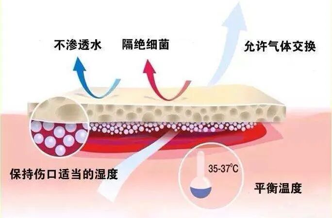 硅凝胶敷料怎么样常规治疗增生性瘢痕首选——硅凝胶敷料！_https://www.jmylbn.com_新闻资讯_第7张