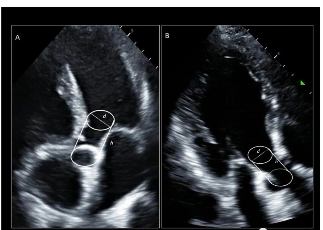 chest怎么量如何通过超声心动图测定每搏量？（CHEST 译文）_https://www.jmylbn.com_新闻资讯_第4张