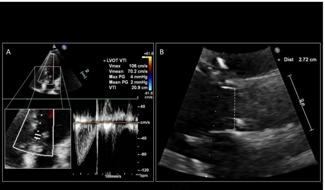 chest怎么量如何通过超声心动图测定每搏量？（CHEST 译文）_https://www.jmylbn.com_新闻资讯_第9张