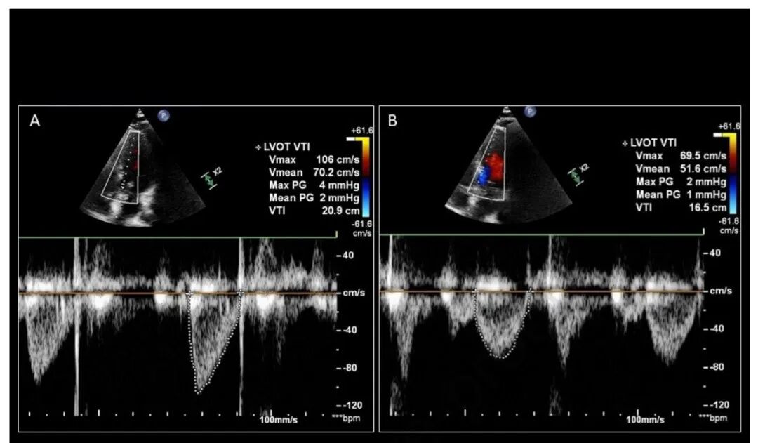 chest怎么量如何通过超声心动图测定每搏量？（CHEST 译文）_https://www.jmylbn.com_新闻资讯_第18张