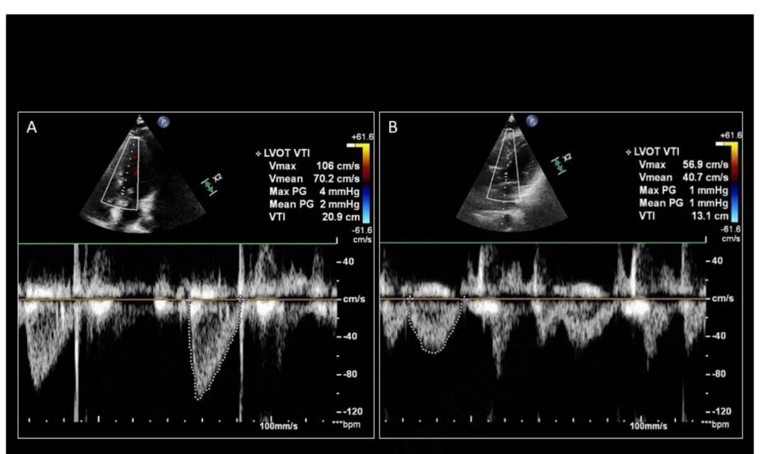 chest怎么量如何通过超声心动图测定每搏量？（CHEST 译文）_https://www.jmylbn.com_新闻资讯_第16张