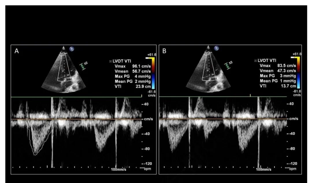 chest怎么量如何通过超声心动图测定每搏量？（CHEST 译文）_https://www.jmylbn.com_新闻资讯_第19张