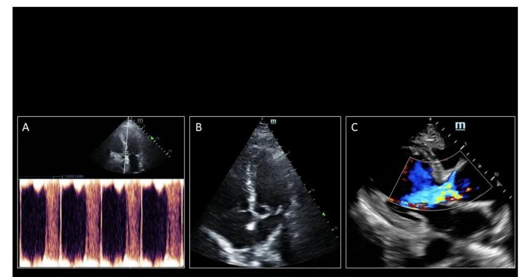 chest怎么量如何通过超声心动图测定每搏量？（CHEST 译文）_https://www.jmylbn.com_新闻资讯_第21张