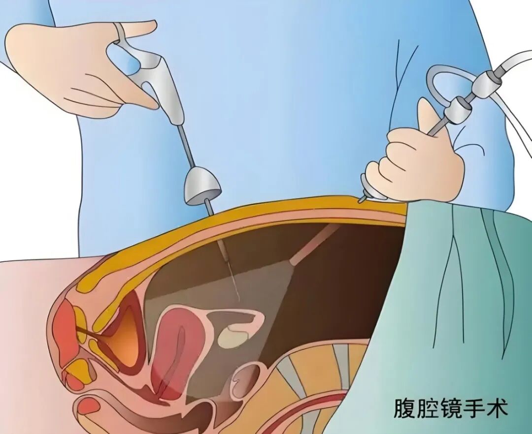 怎样切除子宫