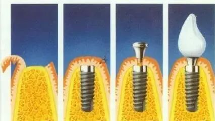 口腔种植手术包怎么打7月2日，北京种植牙专家谭包生教授将来到包医二附院坐诊、手术_https://www.jmylbn.com_新闻资讯_第13张