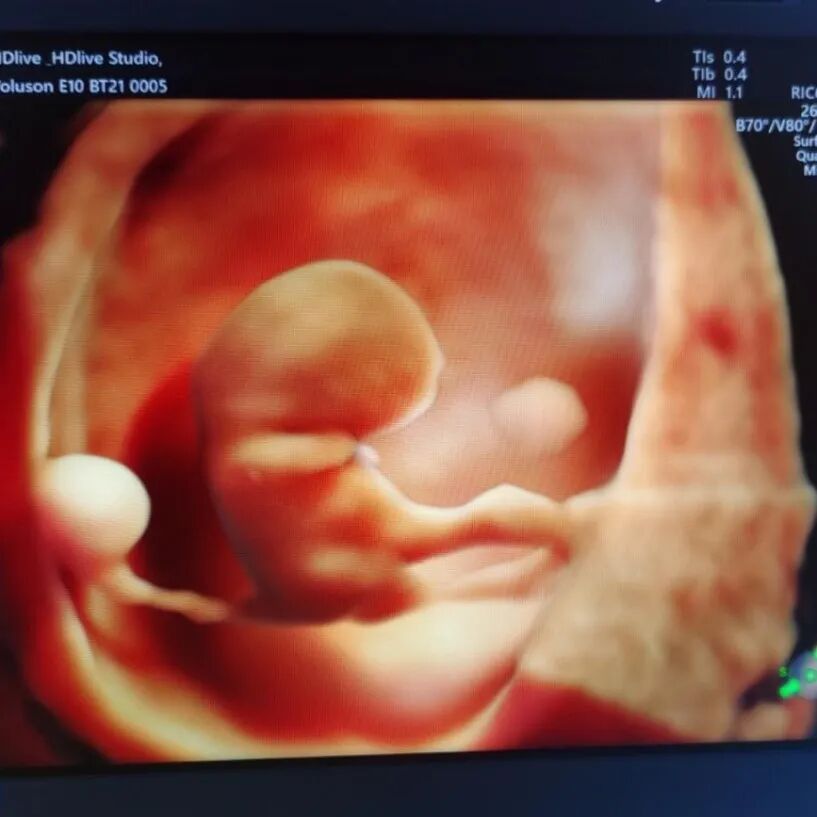 VOlusonE什么彩超机【重磅消息】准妈妈的福音！美国GE Voluson E10彩超进驻柳州二空医院啦！_https://www.jmylbn.com_新闻资讯_第4张