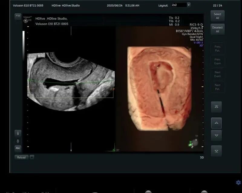 VOlusonE什么彩超机【重磅消息】准妈妈的福音！美国GE Voluson E10彩超进驻柳州二空医院啦！_https://www.jmylbn.com_新闻资讯_第11张