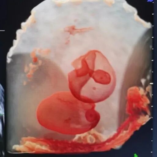 VOlusonE什么彩超机【重磅消息】准妈妈的福音！美国GE Voluson E10彩超进驻柳州二空医院啦！_https://www.jmylbn.com_新闻资讯_第3张