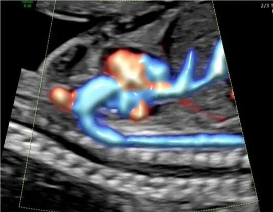 VOlusonE什么彩超机【重磅消息】准妈妈的福音！美国GE Voluson E10彩超进驻柳州二空医院啦！_https://www.jmylbn.com_新闻资讯_第9张