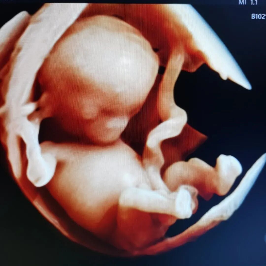 VOlusonE什么彩超机【重磅消息】准妈妈的福音！美国GE Voluson E10彩超进驻柳州二空医院啦！_https://www.jmylbn.com_新闻资讯_第6张