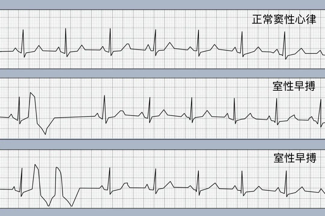 心律失常——室性早搏的诊疗