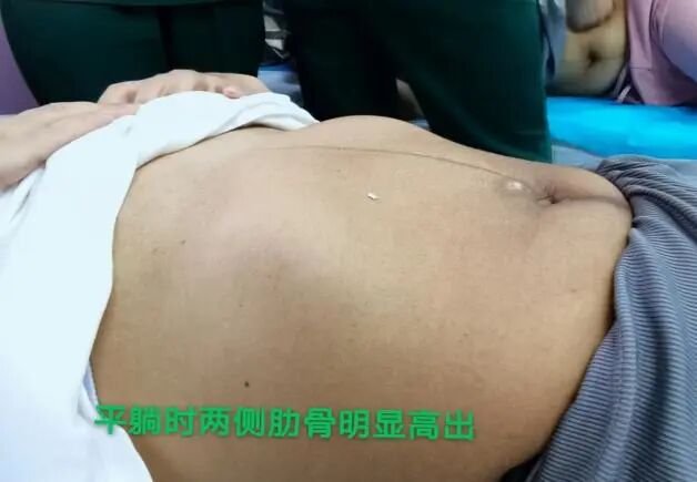 产后胸肋骨疼怎么回事科普丨产后容易被忽略的问题——肋骨外翻_https://www.jmylbn.com_新闻资讯_第7张