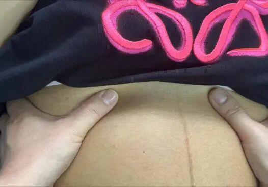 产后胸肋骨疼怎么回事科普丨产后容易被忽略的问题——肋骨外翻_https://www.jmylbn.com_新闻资讯_第15张