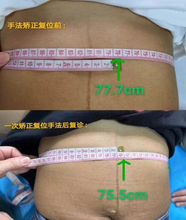 产后胸肋骨疼怎么回事科普丨产后容易被忽略的问题——肋骨外翻_https://www.jmylbn.com_新闻资讯_第10张