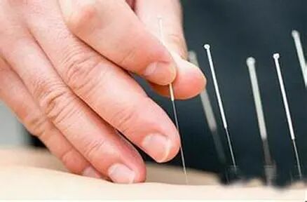 导什么针什么作用“药之不达，唯针可到”中医针灸的功效你知多少？_https://www.jmylbn.com_新闻资讯_第27张