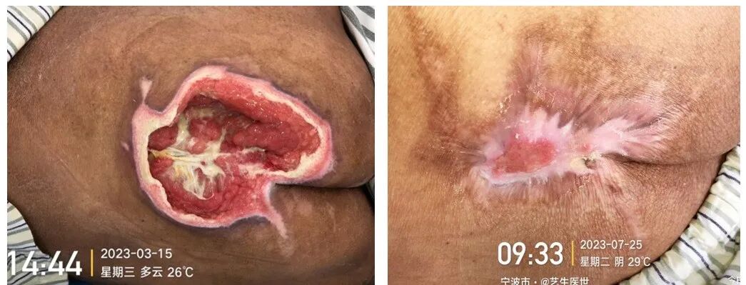 怎么促进vsd伤口愈合碗口大的压疮靠换药能够愈合吗？_https://www.jmylbn.com_新闻资讯_第8张