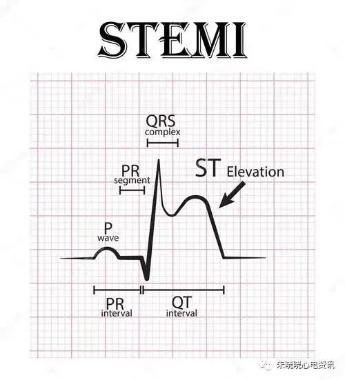 心梗时快速判断梗死部位和范围，实用！