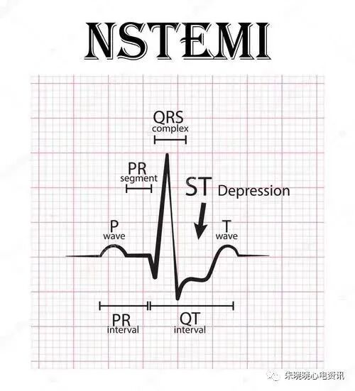 心梗时快速判断梗死部位和范围，实用！