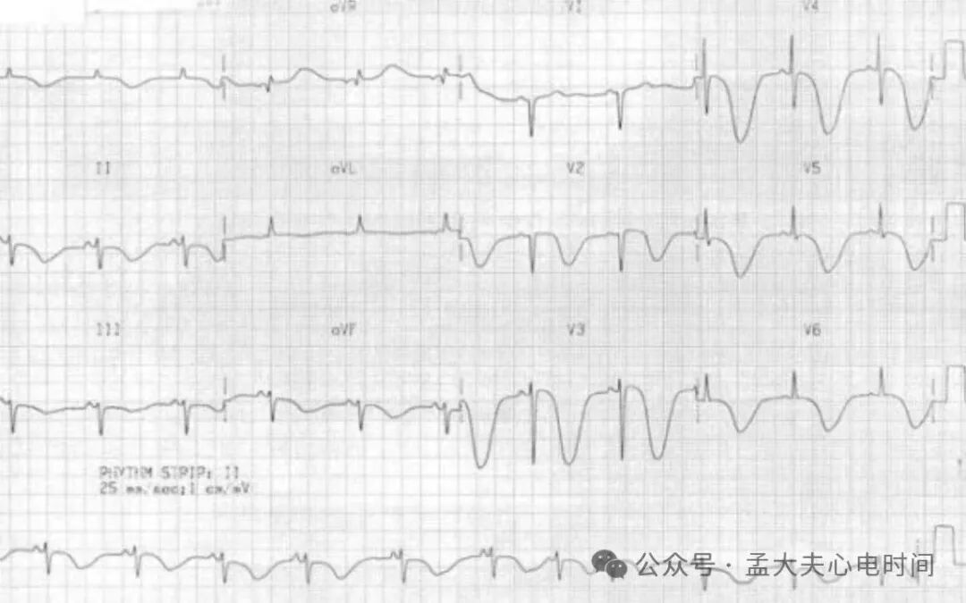 心电图中的“三联征”汇总