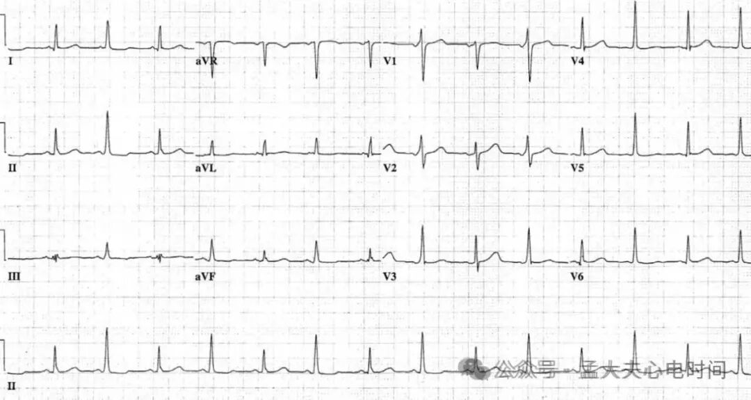 心电图中的“三联征”汇总