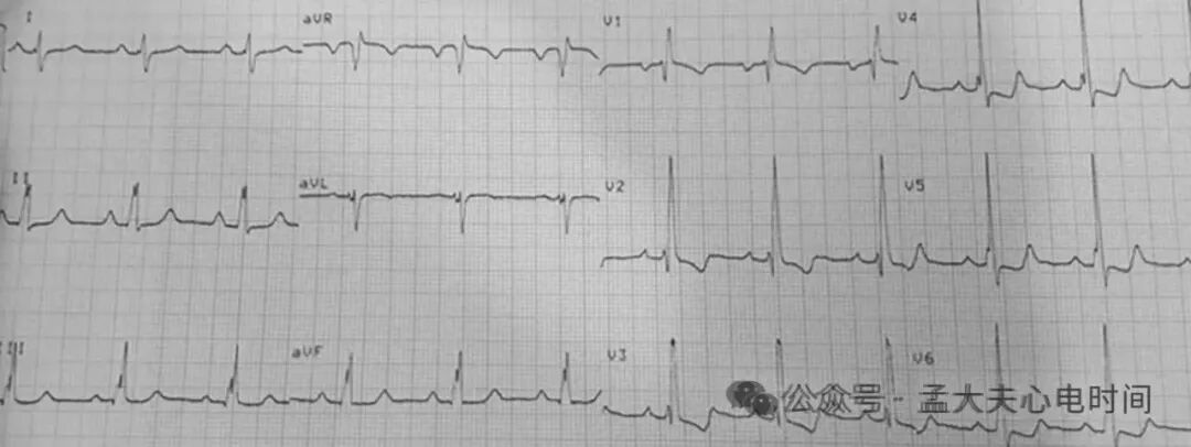 心电图中的“三联征”汇总