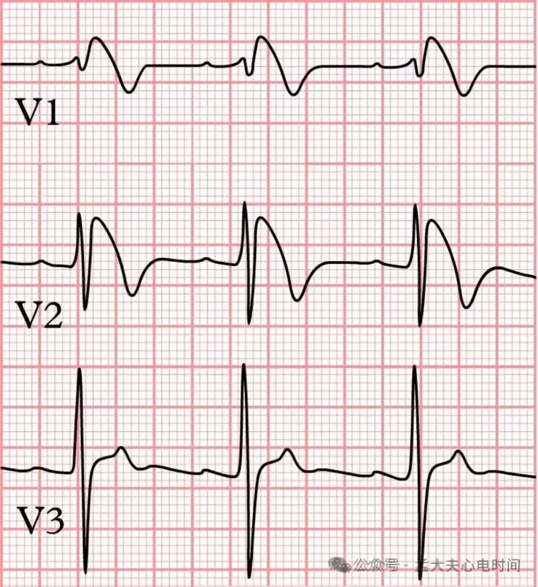 心电图中的“三联征”汇总