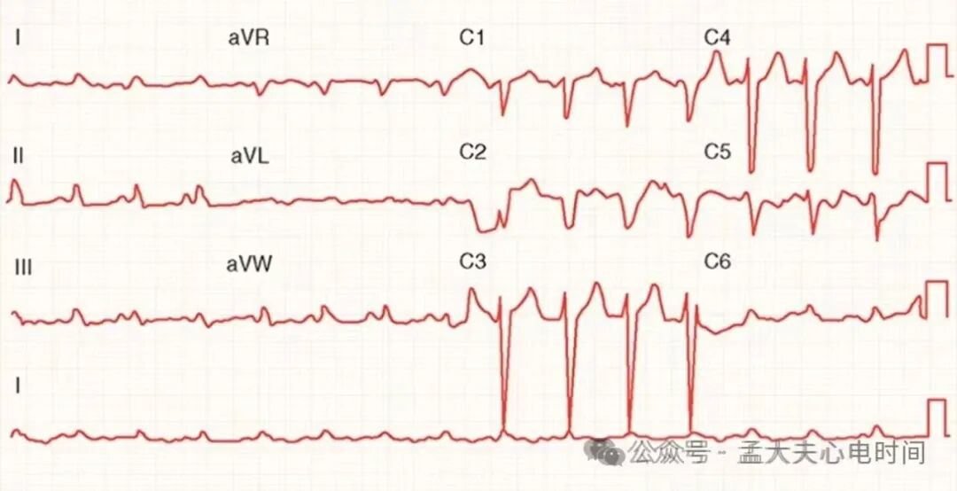 心电图中的“三联征”汇总