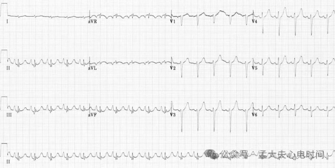 心电图中的“三联征”汇总