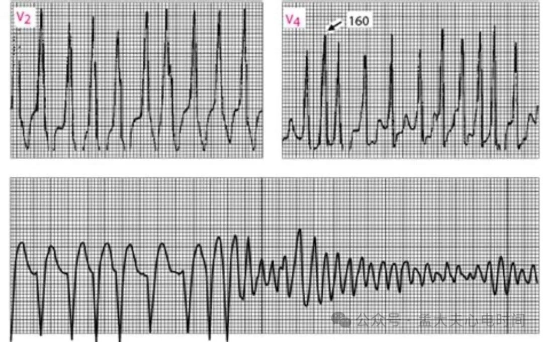 预激综合征合并房颤的心电图诊断及鉴别