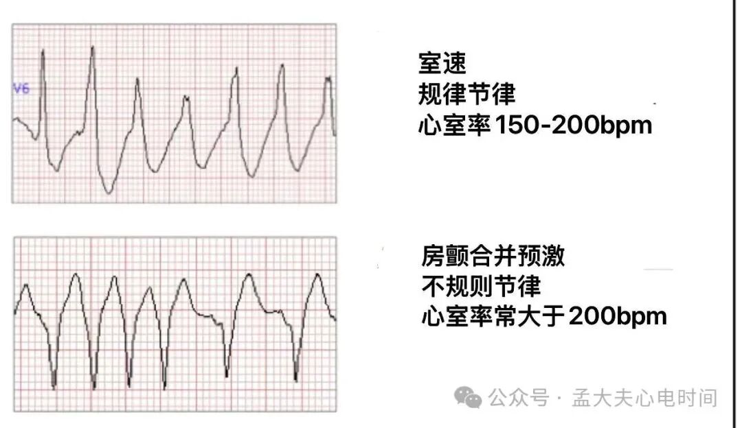 预激综合征合并房颤的心电图诊断及鉴别