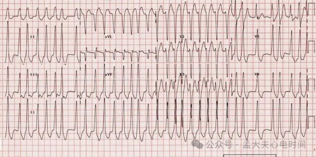 预激综合征合并房颤的心电图诊断及鉴别