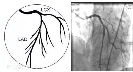 冠状动脉造影？没那么难，这样教你弄懂！