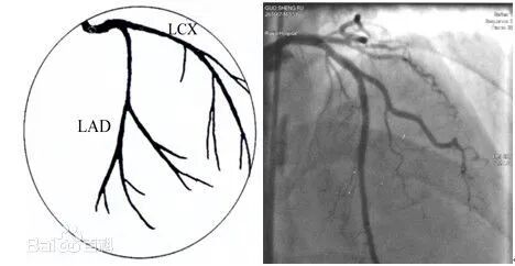 冠状动脉造影？没那么难，这样教你弄懂！